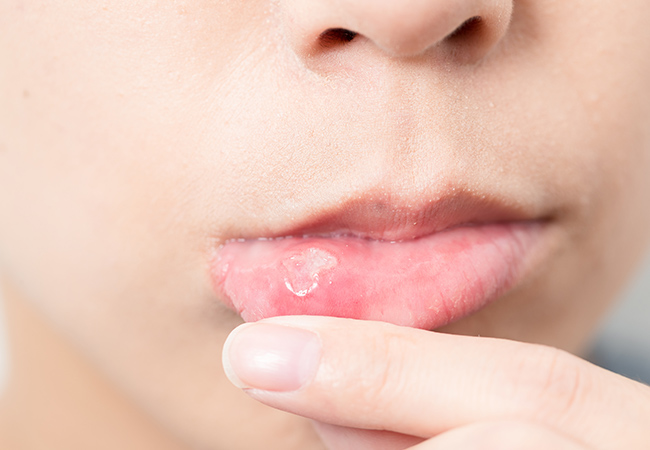口内炎の症状がある下唇