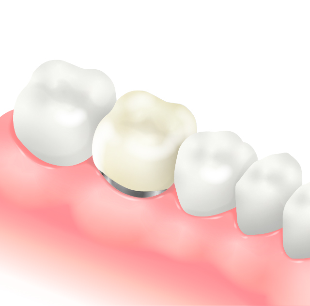 メタルボンドセラミック（従来からある差し歯）