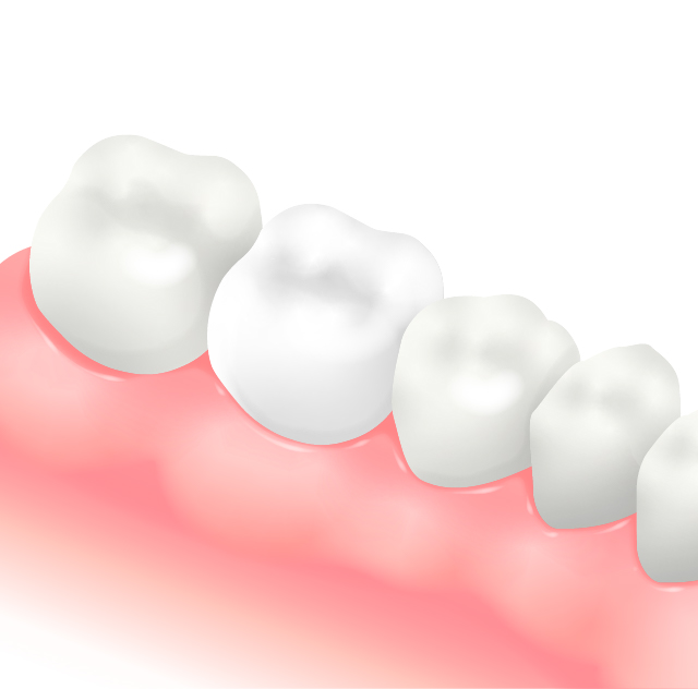 ジルコニア（オールセラミック）